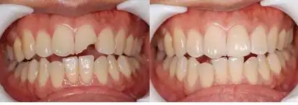 广州美莱整形美容 牙齿美容 种植牙 > 种植牙好还是烤瓷牙好  烤瓷牙