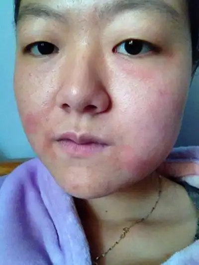 脸上长癣图片 (14)_有来医生