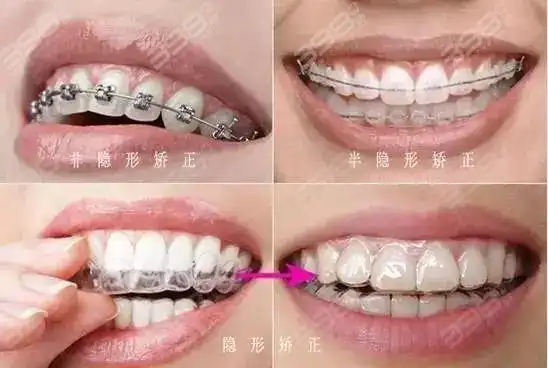 为什么牙龈萎缩了就长不出来了