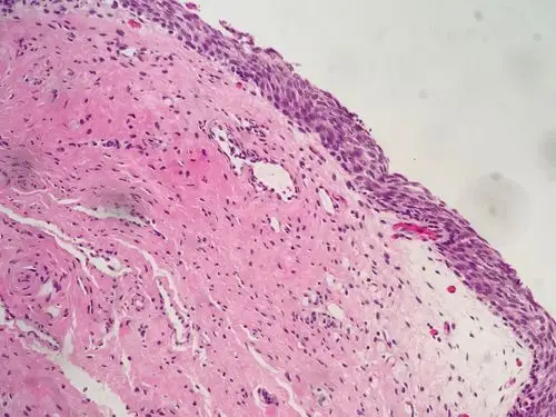 萎缩的子宫颈鳞状上皮细胞