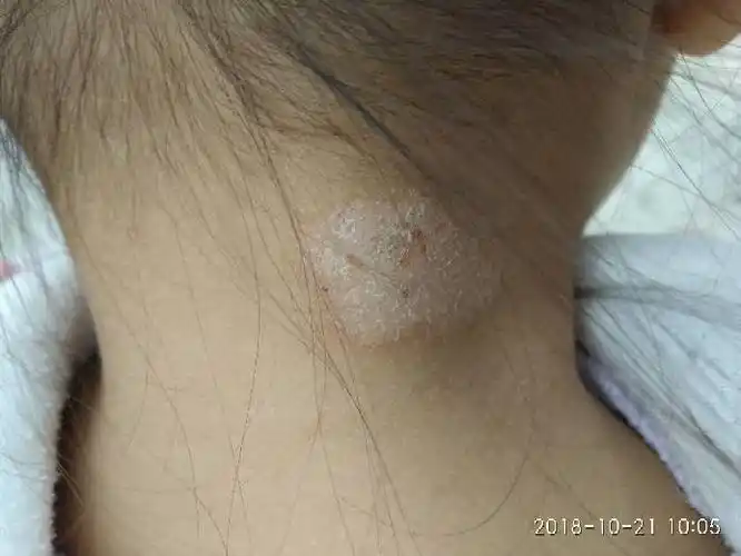 孩子三岁多,脖子后面有图片的样子,最开始就像皮肤烂了一样,之后变成
