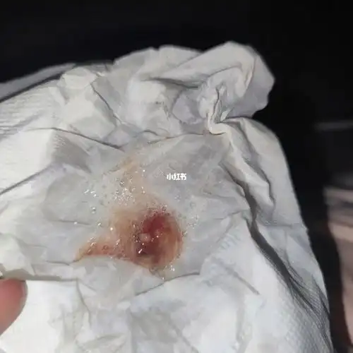 血丝脓物应有尽有我就想着我现在的鼻塞不像那种鼻窦内肿胀 但又像