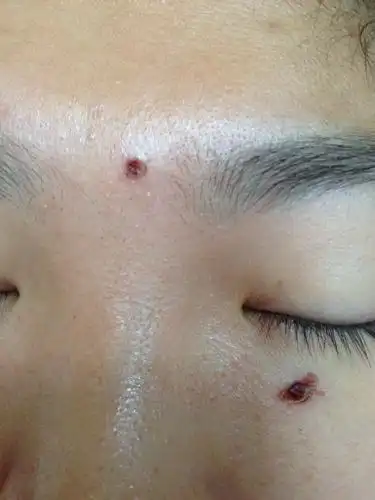 点痣为什么会留下疤痕?,_刘守卫__爱问健康