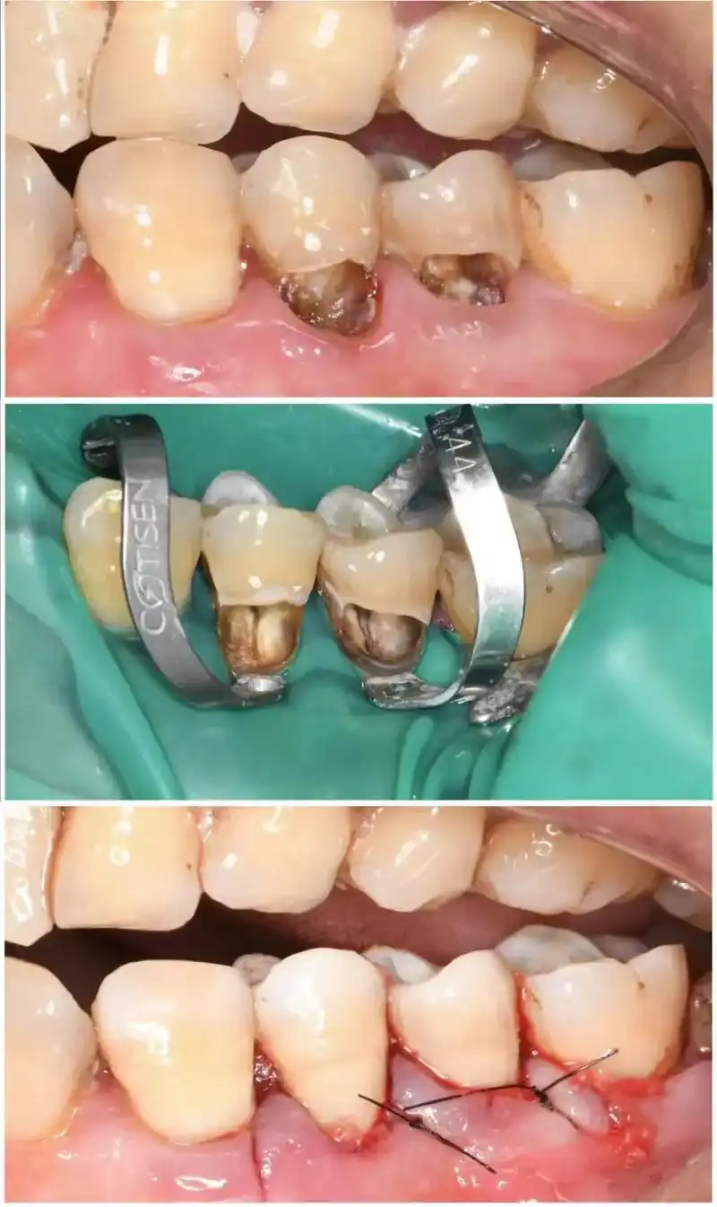 根管治疗77种植