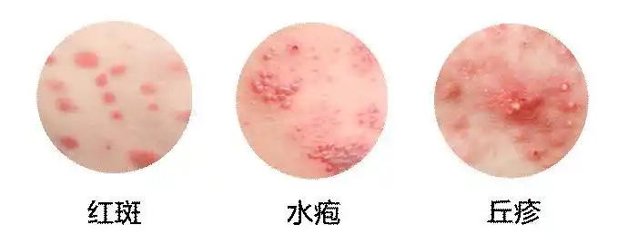7种皮肤病又红又痒积水潭医生教你对图自查