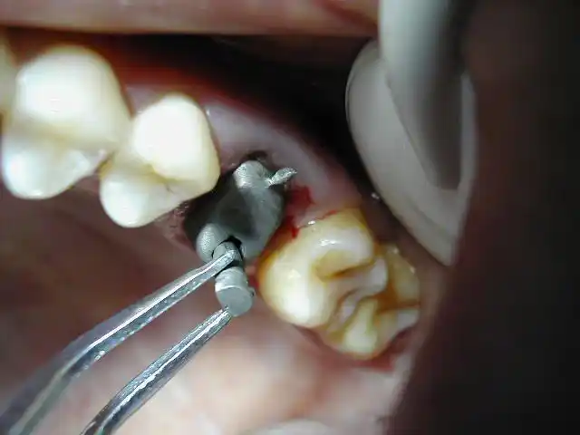 后牙残冠分体桩核修复