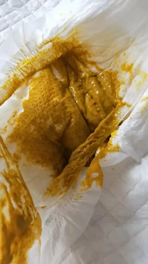 宝宝拉便便是这样的 是腹泻还是