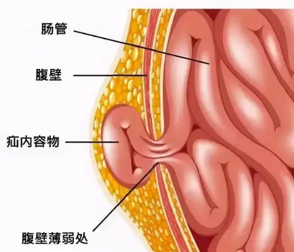 小儿疝气科普 ▏孩子肚子上起包块,腹腔镜手术无创修补|小儿腹股沟疝