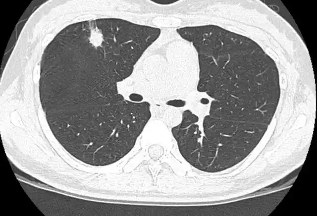 大叔0.6厘米肺结节不放心上,3年没复查变晚期,结节可以不复查吗