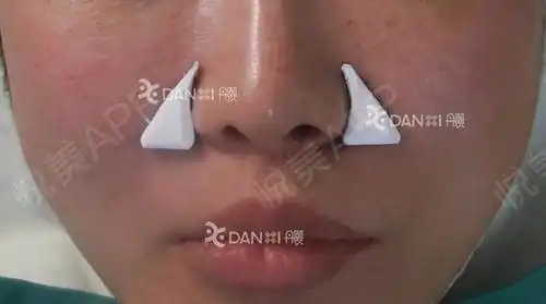 鼻基底填充6mm膨体鼻翼基底术前术后远期对比照片