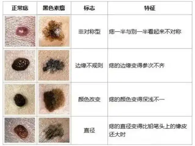 号称"癌中之王"的黑色素瘤,一张图区别痣与黑色素瘤