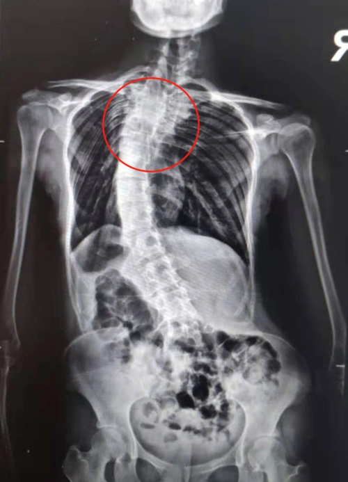 脊柱侧弯八年后实施矫正手术,19 岁女孩「增高」5 厘米