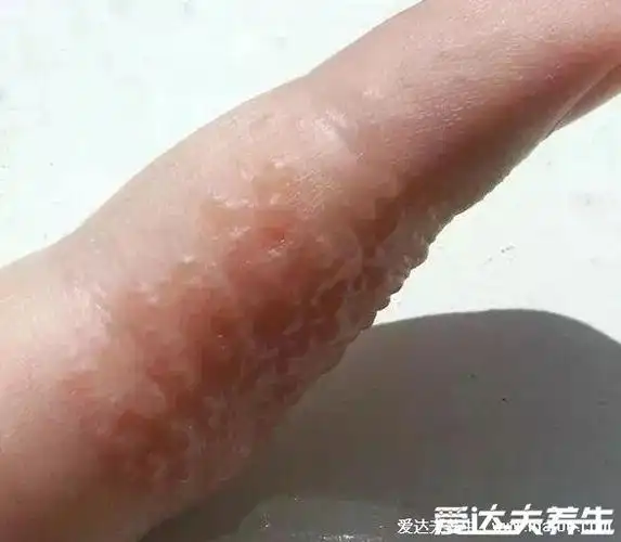 汗疱疹图片初期症状图片,有水疱干后脱皮有瘙痒灼烧感