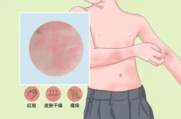 特应性皮炎是一种反复发作的皮肤性疾病,需要到皮肤科进行问诊开药,若