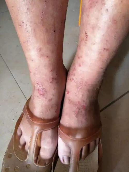 湿疹患者病毒性疱疹过敏性皮炎手癣带状孢疹,蜘蛛疮丘疹性荨麻疹阅读