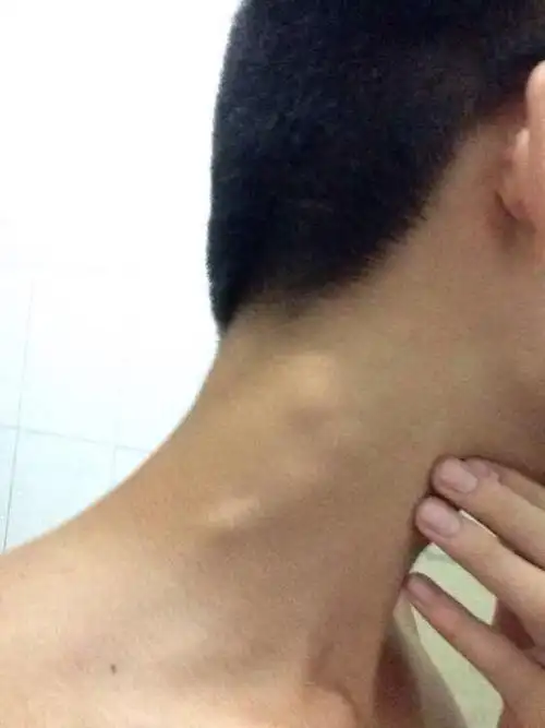 已经有五天了,血常规血沉都正常,超声波做了说是颈部两侧淋巴肿大