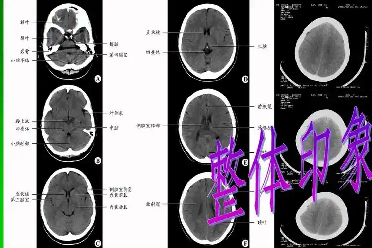 神经外科基础培训 头颅ct判读方法整体印象(中线结构,脑池,脑沟回