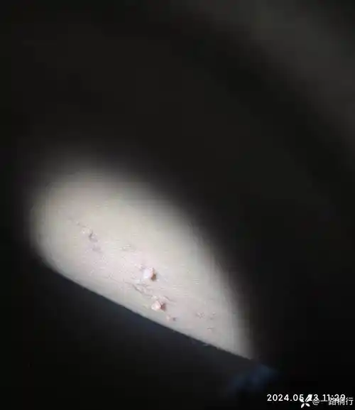 大腿根,丝状疣还是软纤维瘤