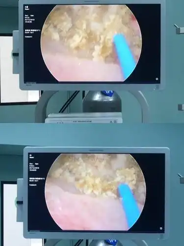 钬激光击碎结石至粉末化