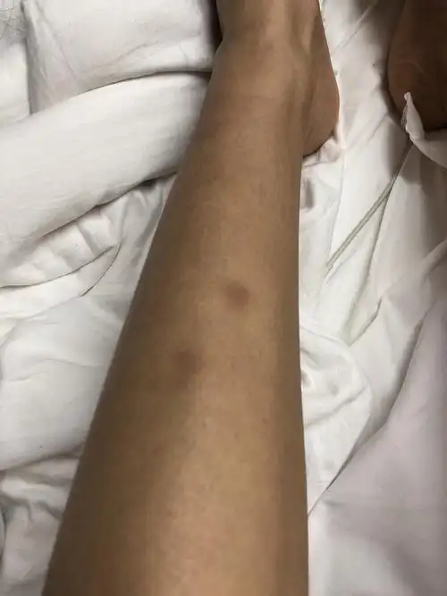 脚上老是青一块怎么回事,最近牙齿经常伴有出血