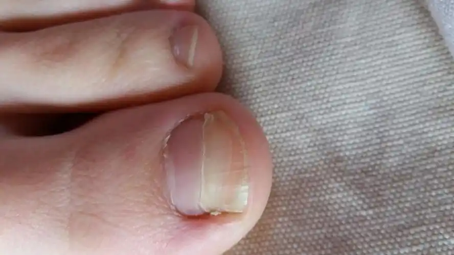 我的脚的大拇指的指甲横向分开了,怎么回事