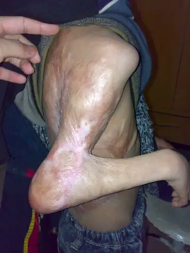 瘢痕挛缩病人,大家给点意见啊.