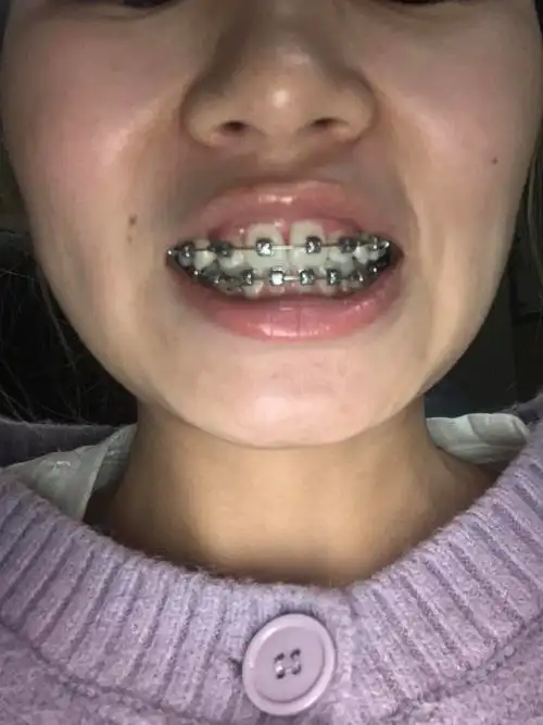 牙槽骨吸收是不是很严重