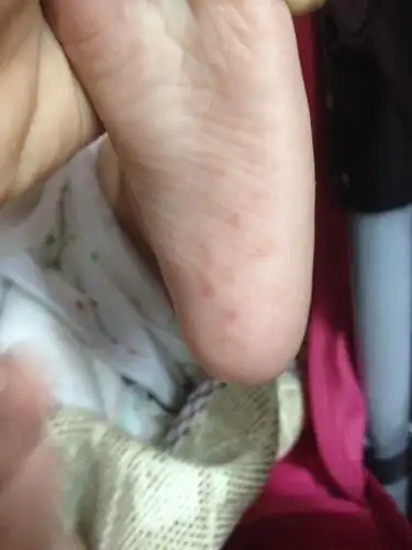 请问这是什么来的,突然才觉得,孩子怎么会在脚底板长这些?