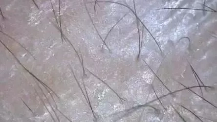 毛囊萎缩或闭合怎么办头发脱不脱毛囊很关键