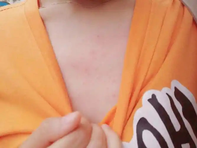 建议平时多清洁床单和被罩,室内还要定期除螨,床垫,衣柜,宠物窝是螨虫