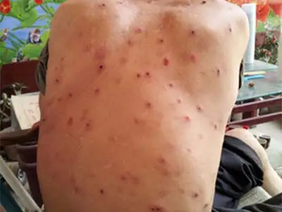 认识不典型水痘的类型