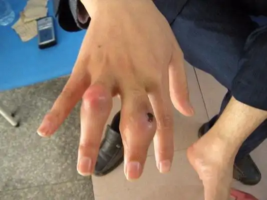 痛风早期症状图片 (57)