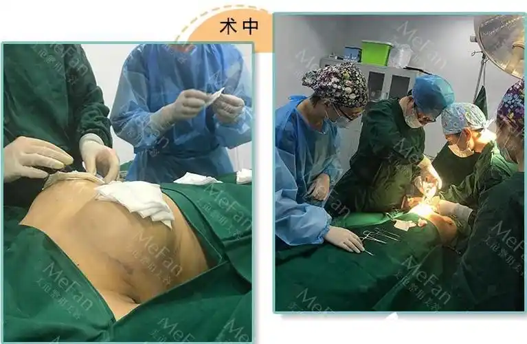 假体隆胸手术过程中