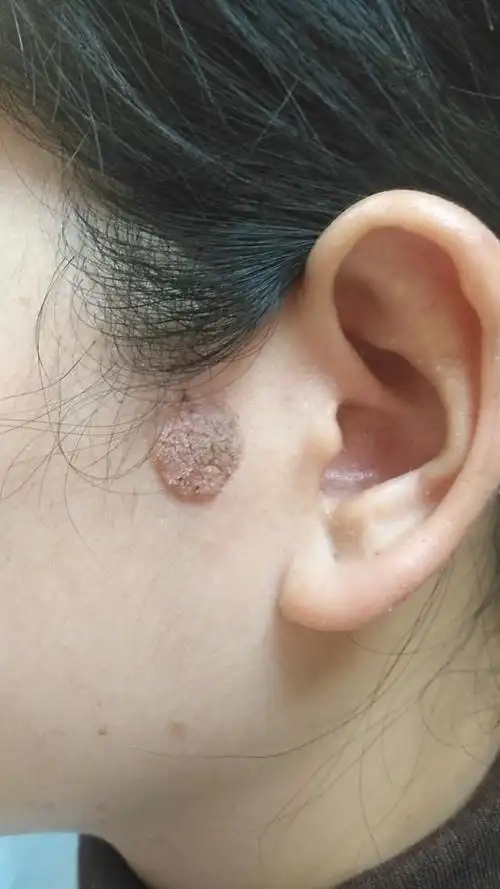 病毒疣1:面部巨大寻常疣不用激光冷冻也可以治好吗? - 好大夫在线