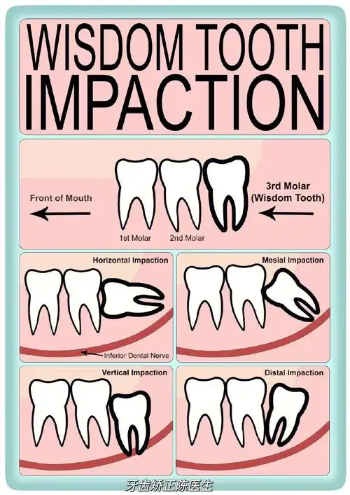 "智齿因为位置关系,在清洁与治疗上都相当不容易,因为不易清洁就容易