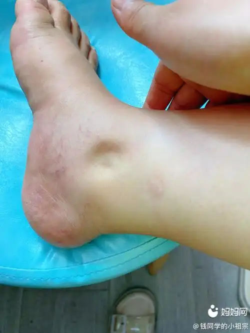 预产期9月16脚踝肿到两个大一按一个坑有同款的宝妈嘛