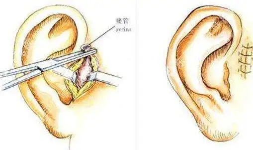先天性耳前瘘管需要注意什么?