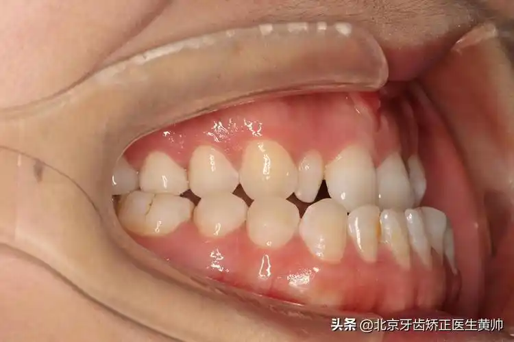 成人骨性地包天,非手术正畸拯救"月牙脸"