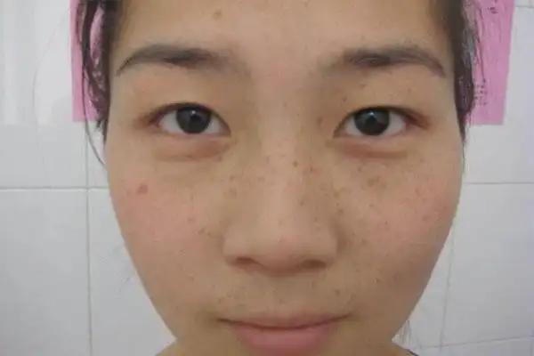 印堂发黑是怎么回事?印堂不同颜色暗示不同病症,要引起重视