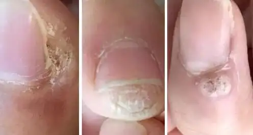 女性hpv病毒女性症状图片 各类型初期小疣体图片