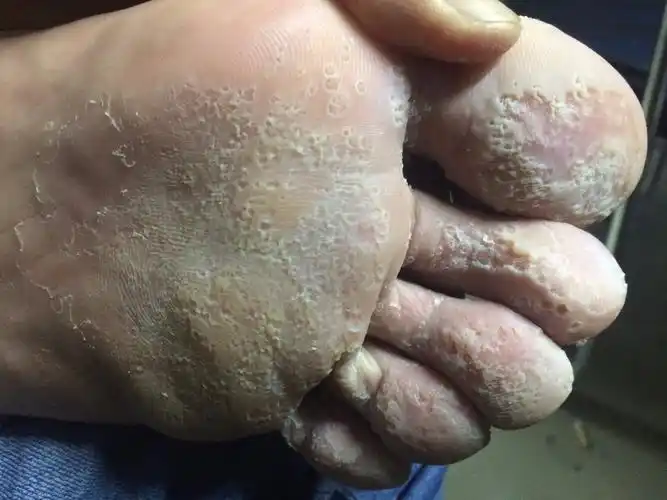 脚底 皮肤很多小坑,很疼