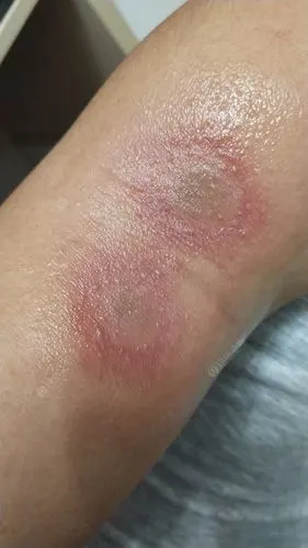 夜钓小心隐翅虫,太毒