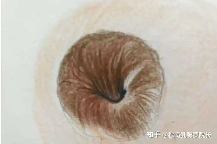 菇凉乳头内陷那些事你知道吗