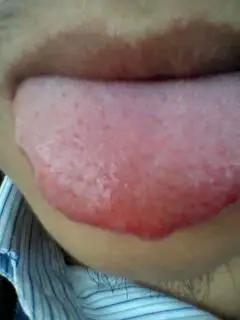 舌头两侧有疙瘩,有一年了,刚发现时候就这