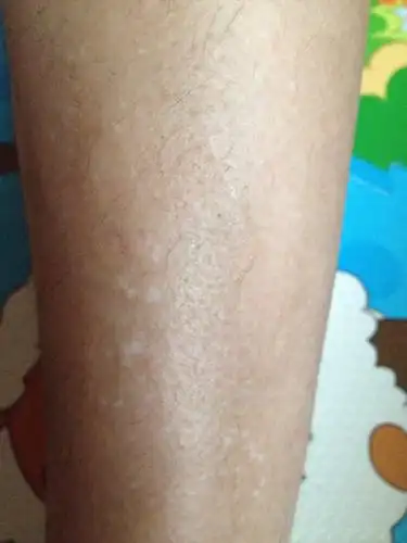 就是这种白色的小点点,都这么小,就小腿了,前两年没这么多,就两年边多