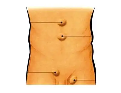 据统计,在深圳,疝气发病率约为5‰,而男性在一生中患腹股沟疝的几率则