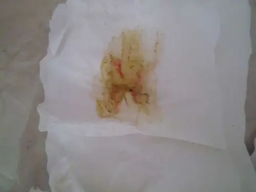 2010-12-21 大便粘液是怎么回事? 3