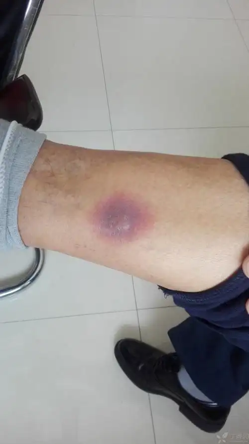 男,48岁,于一年前左下肢静脉曲张术后,近5个月左下肢这样了,是血管