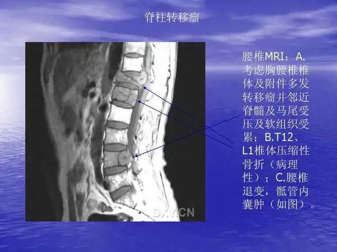 t12, l1椎体压缩性 骨折(病理 性);c.腰椎 退变,骶管内 囊肿(如图).