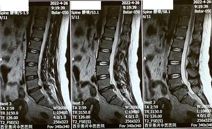 20220426西安长安聂河中医院腰椎磁共振02.jpg
